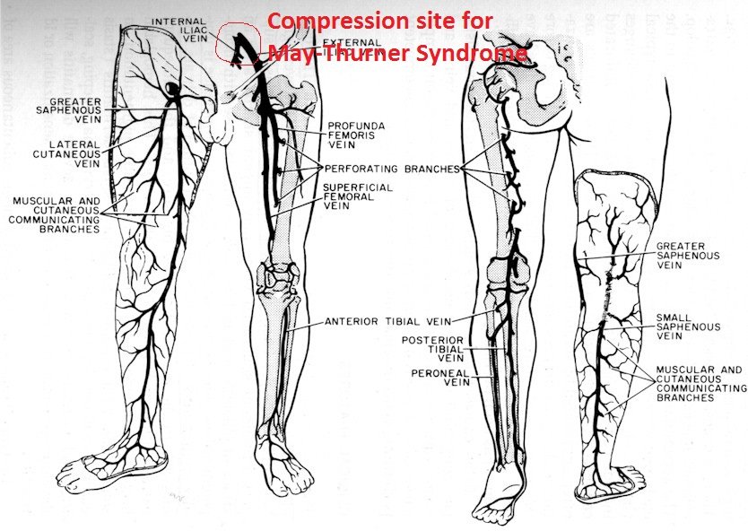 May-Thurner venous compression